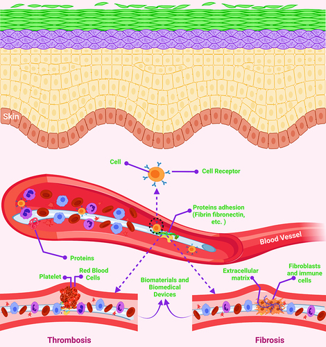 Figure 5 Schematic illustration of the biofouling of biomaterials and biomedical devices.