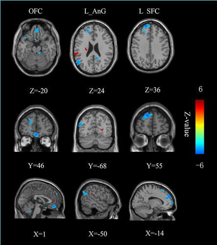 Figure 2 Group-differences of the resting-state functional connectivity of the right NAc. Higher (blue) and lower (red) resting-state functional connectivity was found in the patients with cLBP compared to the HC.