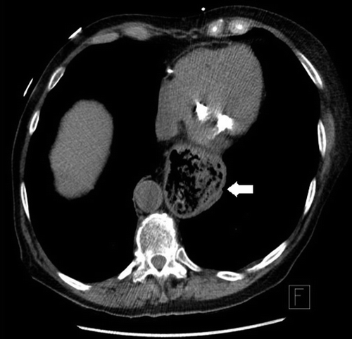 Figure 2. Chest computed tomography axial plane image showing a large hiatal hernia compressing the heart, especially on the left atrium (white arrow).