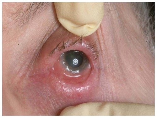 Figure 1 Conjunctival chemosis, loss of contour of the caruncle, and shortening of the fornix.