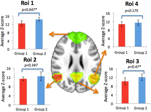 Figure 3. Resting state default mode network regions and corresponding average z-score connectivity values with 1 standard deviation from the mean. Results from Mann-Whitney U-tests at p < 0.05 denoted by *. (Group 1 = injured/traumatic, Group 2 = patriotic).