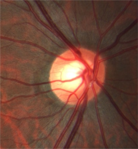 Figure 4 In the unaffected right eye, no intertwining of the vessels is seen.