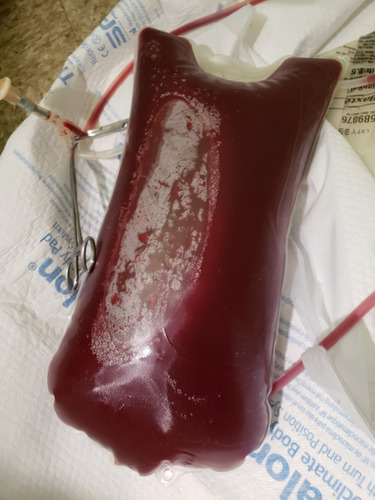 Figure 2 Dialysate effluent bag showing grossly hemorrhagic fluid (Day 9).