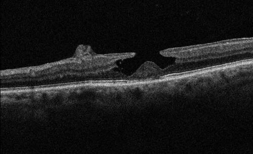 Figure 2 Degenerative lamellar macular hole identified by round-edged intraretinal cavitation, “foveal bump”, and epiretinal proliferation of medium reflectivity.