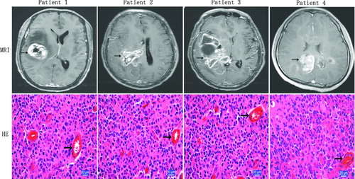 Figure 1  MRI and histopathologic features of human GBMs. MRI reveals irregularly and nonhomogeneously enhancing mass (black arrow) in the right hemisphere zone, and edema zone surrounding solid tumor sometime could be detected in contrast-enhanced T1-weighted imaging. Histopathologically, patient tumor morphology is mitotically active and includes pleomorphic cells, nuclear atypia, abundant microvasculars (black arrow), endothelial proliferation, and necrotic foci (HE staining).