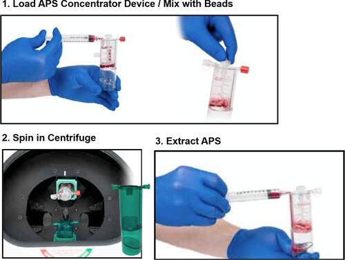 Figure 4 Representative pictures of APS device processing: 1) The APS Concentrator device was gently shaken to ensure beads were evenly distributed across bottom of top chamber. The yellow cap was unscrewed on the APS Concentrator device and filled with the output of L-PRP device from the 10mL syringe. The 10mL syringe was removed and the tether cap on port was attached. The paddle was spun until the cell solution was fully mixed with beads. 2) The concentrator was placed into the centrifuge. The centrifuge was balanced with a counterbalance. The concentrator device was spun for 2 minutes at 2000 RPM. 3) The APS was gently resuspended in the bottom of the APS Concentrator. The red cap was unscrewed and connected to a sterile 10mL syringe. The APS was extracted.