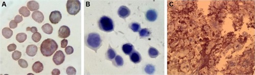 Figure 2 Micrographs obtained after immunohistochemistry test on cell suspensions of (A) SKOV-3 cells (HER-2-positive) and (B) MDA-MB-468 cells (HER-2-negative) to compare the presence of HER-2 receptors; and (C) micrographs of SKOV-3 tumor tissue, indicating the presence of HER-2 receptors on cell membrane (considered as 3+ score), defined as strong complete membrane staining in more than 30% of tumor cells.
