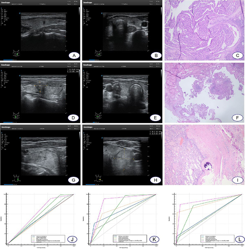 Figure 1 Typical ultrasonic imaging of thyroid nodules in each groups and ROC curves of each group. Longitudinal section (A) and transverse section (B) showed a left thyroid nodule ≤10 mm, postoperative pathology showing papillary thyroid microcarcinoma (C). Longitudinal section (D) and transverse section (E) showed a right thyroid nodule >10 mm, <20 mm, postoperative pathology showing papillary thyroid microcarcinoma (F). Longitudinal section (G) and transverse section (H) showed a left thyroid nodule ≥20 mm, postoperative pathology showing follicular adenoma (I). ROC curve of A1 group (J). ROC curve of A2 group (K). ROC curve of A3 group (L).