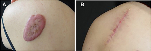 Figure 6 Example of keloid treated with excision followed by radiotherapy. (A) Before treatment, (B) at 6 months of follow-up.