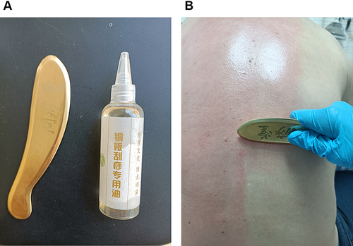 Figure 1 (A) Instruments used for Gua Sha therapy in the study. (B) Press-strokes were repeated in one location until appearance of petechiae.