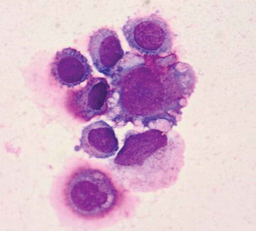 Figure 4. Cytological examination of cerebrospinal fluid staining confirmed meningeal metastasis from peritoneal mesothelioma. Cerebrospinal fluid staining showing that cells had larger bodies and irregular nuclei, visible nucleolus, abundant cytoplasm, and deep staining (200×).