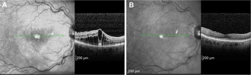 Figure 4 Spectral-domain optical coherence tomography showing improvement in cystoid macular edema following implantation of sustained-release dexamethasone intravitreal implants in patient with central retinal vein occlusion in right eye.