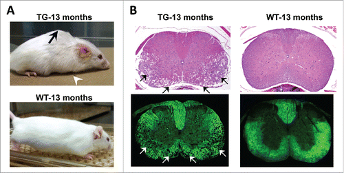 Figure 1. Spinal cord degeneration in a mouse model of ADLD. (A) PLP-FLAG-LMNB1 transgenic mice (TG), with oligodendrocyte specific overexpression of lamin B1, show age dependent degenerative phenotypes including kyphosis (black arrow), forelimb paralysis (white arrowhead) and muscle wasting at 13 months while wild type (WT) littermates show no obvious phenotypes. (B) Cervical spinal cords section of TG mice show significant vacuolar degeneration involving the white matter (arrows). No such alterations are observed in spinal cord sections from WT littermates. Top panel – H&E staining, Bottom panel – Fluormyelin staining (Fluromyelin is a fluorescent dye that specifically stains white matter). Reproduced with permission from Rolyan et al., (2015).Citation19