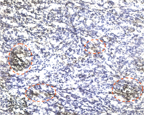 Figure 6. Interleukin-12 staining. The red circles outline some of the areas staining positive for IL-12 in a haematoxylin background in the AdhspmIL-12 + HT group. This image is from one of the tumours collected 5 days post HT (100×). In the control, Ad LacZ + HT, AdhspmIL-12 alone and HT alone groups no IL-12 was detected in the immunohistochemically stained tumour sections.