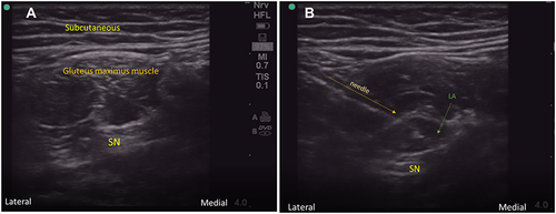 Figure 2 Sciatic nerve block: (A) SN sciatic nerve. (B) LA local anesthetic.