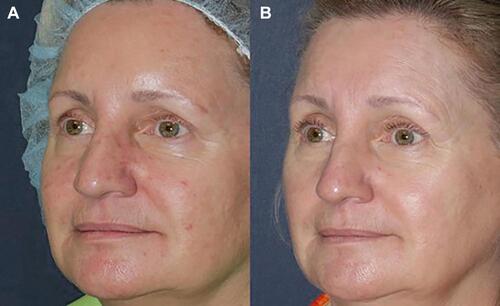 Figure 6 Before (A) and after (B) ALA-PDT for treatment of rosacea with PDL, IPL, and blue/red light. Figure courtesy of Dr. Goldman.