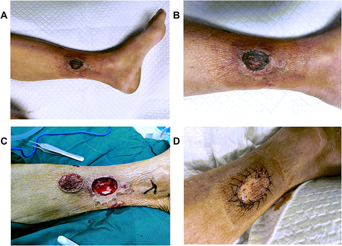 Figure 1 This patient’s left lower limb. (A and B) Upon admission to our hospital. Ulceration of the left lower extremity 10 cm above the ankle joint, and an oval skin gangrene about 5 cm in diameter was seen 10 cm above the ankle joint of the left lower extremity. (C) Intraoperative clearance on August 24, 2022. (D) Post-implantation on September 1, 2022.