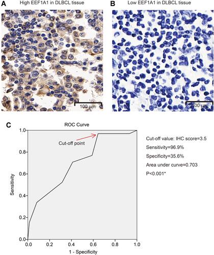 Figure 2 Protein expression level of EEF1A1 in DLBCL. Representative high (A) and low (B) protein immunostaining of EEF1A1 of DLBCL tissues. The ROC curve was plotted to determine a cut-off value to distinguish high- and low-EEF1A1 expression (C). * indicates P<0.05.