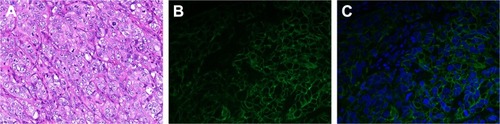 Figure 9 Immunofluorescence images of tumor-tissue slices (400×).Notes: (A) H&E staining of tumor. (B) Fluorescein isothiocyanate–labeled tumor cells (green) of tumor sections. (C) DAPI-labeled tumor-cell nuclei (blue) of tumor sections.