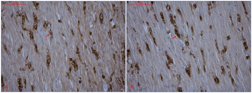 Figure 3. Immunohistochemic analyses of gastric antrum wall autopsy specimens visualizing PGP 9.5-IR nervous tissue (dark brown) in (A) a patient with hereditary TTR amyloidosis and (B) A non-amyloidosis control. A ×40 objective (40×/0.70, Pl Fluotar, Leica) was used for the analyses. PGP 9.5 = protein gene product 9.5.