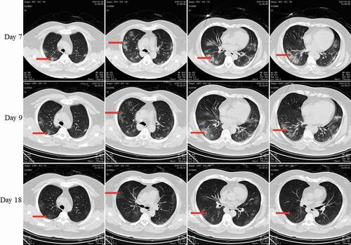 Figure 3. Chest CT scans on days 7, 9, and 18 after onset for Pt-1. CT showed scattered bilateral multiple high-density effusions on day 7. The high-density effusions were absorbed on day 9 compared to day 7, and obvious absorption was observed on day 18. Red arrows indicate typical lesions.