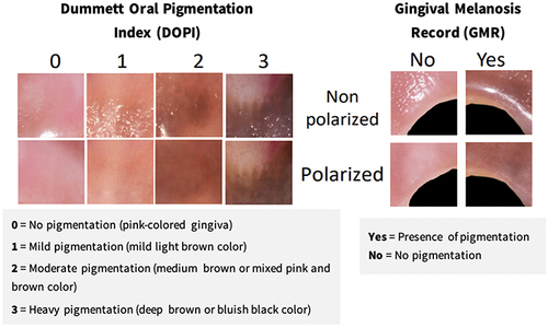 Figure 5 Measurement of gingival pigmentation with the Dummett Oral Pigmentation Index (DOPI) and Gingival Melanosis Record (GMR).