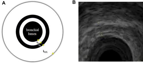 Figure 1 (A) Outline of bronchial wall layers. (B) Schematic measurement the thicknesses of total bronchial wall and its particular layers in EBUS in a patient with ACO.