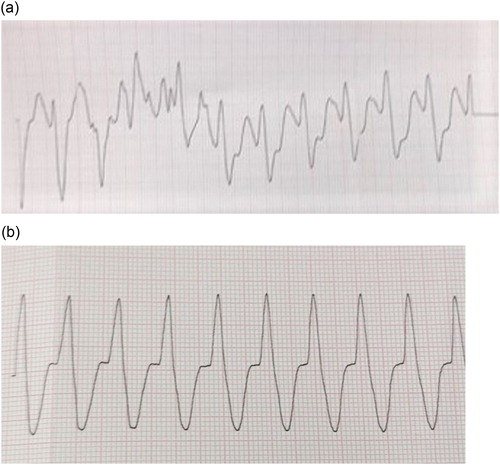 Figure 1. (a) Initial pulseless ventricular tachycardia rhythm strip. (b) Pulseless ventricular tachycardia rhtythm strip after 10 minutes of care.