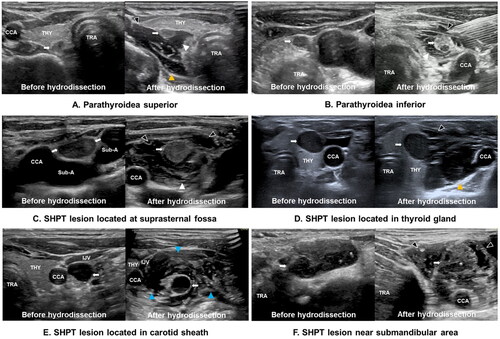 Figure 5. (A-F) Ultrasound images of SHPT lesions (White arrow) at different locations before and after improved hydrodissection. Pretracheal space hydrodissection (white arrowhead), retropharyngeal space hydrodissection (yellow arrowhead), anterior cervical space hydrodissection (black arrowhead), and carotid space hydrodissection (blue arrowhead) are shown as anechoic or mixed echoic bands on the images. Note: THY, thyroid; ESO, esophagus; TRA, trachea; CCA, common carotid artery; IJV, internal jugular vein; Sub-A, subclavian artery; SHPT, secondary hyperparathyroidism.