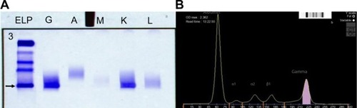 Figure 2 Serum immunofixation electrophoresis and its graphical representation.