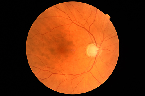 Figure 2 Funduscopic image of glaucomatous optic disc in 72-year male (right eye).