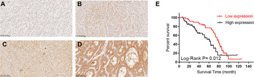 Figure 2 The Immunohistochemical staining of TASP1 expression in HCC tissues and survival curve.