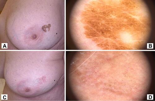 Figure 8 Case 2. (A and B) Macro-photo and dermoscope picture of large seborrheic keratosis on left breast before HIFU. (C and D) Macro-photo and dermoscope picture of treated area at control visit 4 weeks after HIFU treatment.