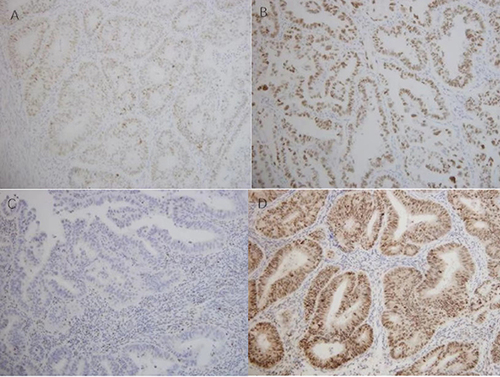 Figure 1 The immunohistochemical staining results for p53 protein. (A) Wild-type p53, varying proportions and intensities of nuclear staining in tumor cells; (B) Aberrant nuclear overexpression of p53, strong nuclear staining in tumor cells compared to internal controls; (C) Complete loss of p53 expression, no p53 staining in tumor cell nuclei, with internal controls showing variable but moderate to strong staining. (D) Subclonal p53 mutation, with partial tumor cell cytoplasm showing diffuse moderate or strong positivity and no nuclear staining, accompanied by abnormal nuclear overexpression in some tumor cells.(Original magnification ×20).