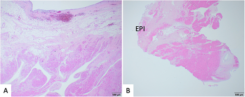 Figure 4 Histological images from a subject with biventricular arrhythmogenic cardiomyopathy. (A) Right ventricular free wall with fibrofatty myocardial replacement and relative preservation of myocardium within trabeculations. (B) LV apical core from assist device placement with accentuated fibrofatty myocardial replacement towards the epicardium (EPI).