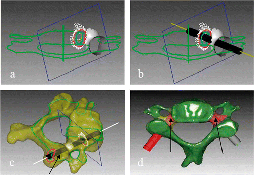 Figure 2. Analysis of cervical pedicle screw trajectory by the reverse engineering software. (a) Pedicle and its positive projection. (b) Best trajectory of pedicle screw projection. (c) Pedicle screw channel (arrow). (d) Planned screw trajectories (arrows).