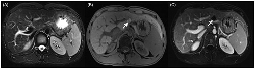 Figure 4. 11 months after MWA, the MRI of the same patient as in Figures 2 and 3. (A) The fsFRFSE T2WI demonstrated the ablated lesion was isointense. (B) The unenhanced 3 D Dyn TIWI demonstrated the ablated lesion was hyperintense (arrow). (C) The enhanced equilibrium phase MRI displayed an unenhanced ablated lesion (arrow).