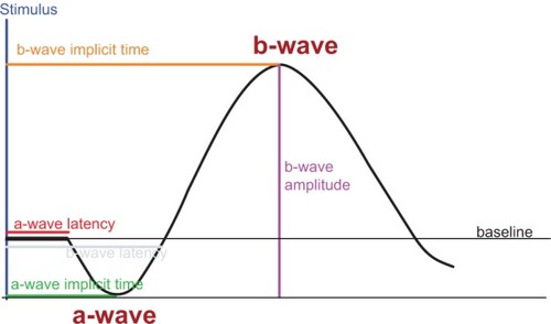 Figure 1 The a-wave of the electroretinogram reflects the activity of photoreceptors; the b-wave indicates the activity of the amacrine, horizontal, bipolar, and Müller cells. Implicit time refers to the time occurring between the initiation of the light stimulation (flash) and the peak of a- and b-waves. The a-wave amplitude was measured from baseline to a-wave trough; the b-wave amplitude was measured from a-wave trough to b-wave peak.