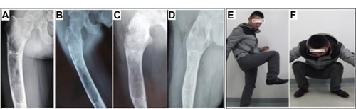 Figure 5 A 20-year-old man suffering from fibrous dysplasia of the right proximal femur.Notes: (A) The original image of the defect site. Periodic radiological assessments showed (B) during the period of 6 months, 50% of the grafting zones were replaced by new bones, and (C) fully occupied at 1.5 years after surgery. (D) With a more than 5 years follow-up, the porous n-HA/PA66 composite had been completely incorporated with the host bone. (E and F) grafting-to-non-lesion count ratio was 0.83, the patient was satisfied with the result, and the MSTS was 30.Abbreviations: n-HA/PA66, nano-hydroxyapatite/polyamide 66; MSTS, Musculoskeletal Tumor Society score.