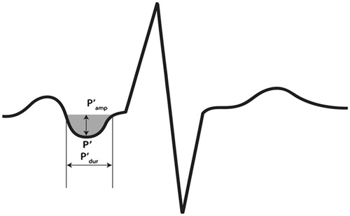 Figure 1. Illustration of components of P-wave terminal force (PTF-v1), defined as the duration (ms) of the downward deflection (shaded grey area) of the P-wave in lead v1 multiplied by the absolute value of its amplitude (μV).