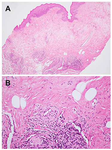 Figure 2 Histopathological findings (hematoxylin-eosin): (A) focal atrophic epithelium with hydropic degeneration of the basal cell layer and edematous and homogenized collagen fiber in the superficial lamina propria (original magnification x100), (B) patchy, band-like lymphoplasmacytic inflammatory infiltration below the hyalinized area (original magnification x400).
