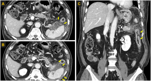 Figure 2 Computed tomography images of the abdomen obtained in January 2018. (A) Computed tomography image of the pancreas showing heterogeneous fluid collection and fat infiltration (yellow arrows) around the tail. (B) Computed tomography image showing splenic subcapsular fluid collection (yellow arrows). (C) Computed tomography image showing secondary colitis at the descending colon (yellow arrows).