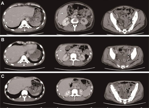 Figure 1 Computed tomography (CT) image before and after the chemotherapy. (A) CT performed before the first-line chemotherapy administration (September 2014). (B) CT performed following two cycles of first-line chemotherapy and before commencing second-line therapy. (C) CT performed 4 weeks after the initiation of anti-EGFR antibody combined second-line chemotherapy. The black arrows show the primary lesion, while the white arrows denote the liver metastases.