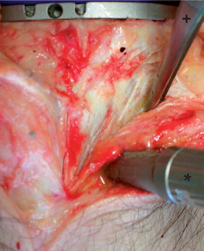 Figure 2. Subperiosteal release of the tibial attachment of the semimembranosus with the trial components and the tibial navigation reference array (*) in situ, and pincette (+).