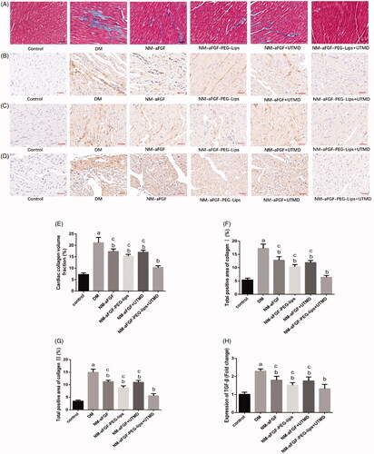 Figure 4. Effects of NM-aFGF-PEG-lips combine with UTMD on cardiac interstitial fibrosis of diabetic rats. (A–D) Representative images of Masson staining and immunohistochemistry staining with collagen I, collagen III and TGF-β1 (400 × ,bar = 50μm). (E) Quantitative analysis of collagen volume fraction (CVF) of rats. N = 10 per group. (F–H) Quantitative analyses of the expression of collagen I, collagen III and TGF-β1, respectively. N = 10 per group. Data are presented as Mean ± SD. ap < .05 vs control group; bp < .05 vs DM group; cp < .05 vs NM-aFGF-PEG-lips + UTMD. NM-aFGF-PEG-lips: non-mitogenic acidic fibroblast growth factor- PEGylated -liposomes; DM: diabetes mellitus; UTMD: ultrasound-targeted MB destruction.