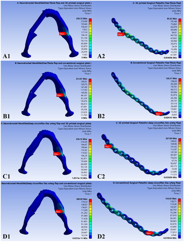 Figure 8. Von Mises stress distribution of the mandibles reconstructed using free fibula flap (A1 and B1), deep circumflex iliac artery flap (C1 and D1), 3D-printed surgical plate (A2 and C2), and conventional surgical plate (B2 and D2).