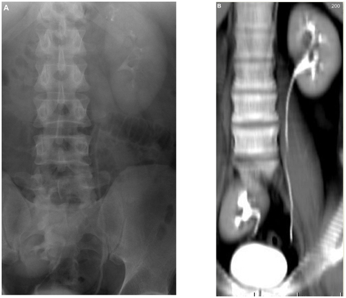 Figure 1 Ectopic pelvic right kidney. Intravenous urography (A) and computed tomography urography (B) both show the right kidney at the pelvic region with adequate excretory function and normal calyceal configuration. Computed tomography urography shows better adequate visualization of the renal parenchyma.