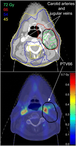 Figure 1.  a) Original dose distribution (with IV contrast) for the patient with the largest dose variation in terms of maximum point dose (0.1 cm3) to PTV66. The dose difference for the plan without IV contrast minus the plan with IV contrast is overlaid on the CT data, showing the largest differences in dose are near the blood vessels, less than 0.7 Gy over 30 fractions (b).