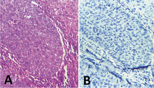 Figure 5. A: Photomicrograph showing moderately differentiated non-keratinized squamous cell carcinoma [H&E, magnification x200], B: Photomicrograph showing negative staining of p16 of the same case [p16-INK4a, original magnification x200].