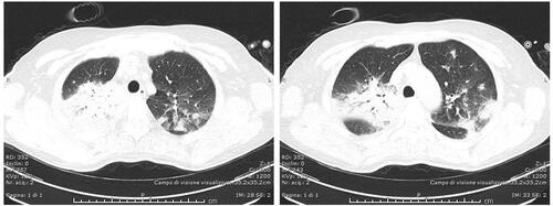 Figure 3 Consolidating pneumonia before starting gilteritinib.